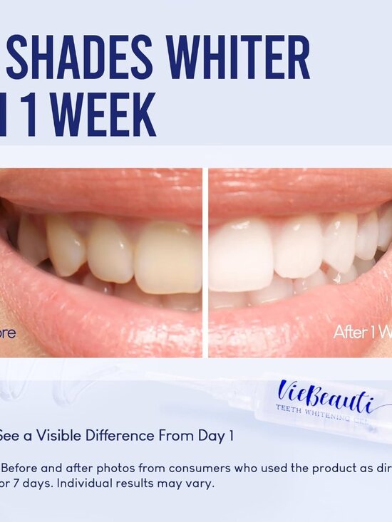 Teeth Whitening Kit with LED Light for Sensitive Teeth - Picture 2 of 8